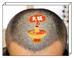 -大麦微针植发全国连锁