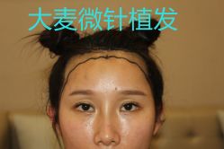 -大麦微针植发丨全国连锁