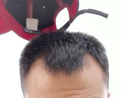 点击看大图 体验前-大麦微针植发全国连锁