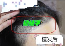 -大麦微针植发全国连锁