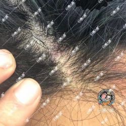 -美人痣全国连锁