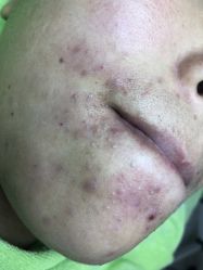 -苗医生草本科技祛痘