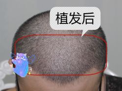 -大麦微针植发全国连锁