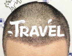 -大麦微针植发全国连锁