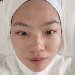 -珍贞佰俪·针清祛痘印敏感管理