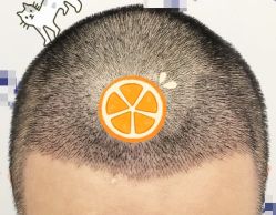 -大麦微针植发全国连锁