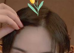 点击看大图 -大麦微针植发全国连锁