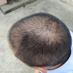 -碧莲盛·不剃发植发