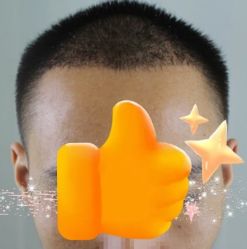 -大麦微针植发丨全国连锁