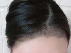 -大麦微针植发丨全国连锁