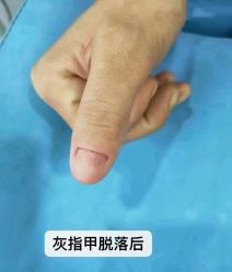 -德哥灰指甲脚气甲沟炎跖疣护理