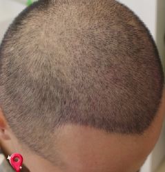 -大麦微针植发丨全国连锁