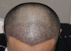 -大麦微针植发丨全国连锁