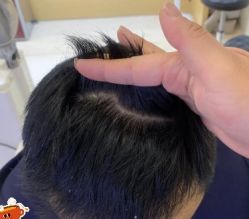 -大麦微针植发丨全国连锁