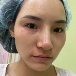 体验后-依萱绮医疗美容