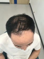 体验前-大麦微针植发全国连锁