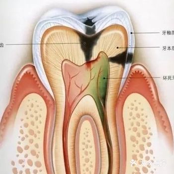 补牙要乘早--小鑫的建议