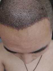 点击看大图 -大麦微针植发丨全国连锁