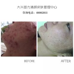 点击看大图 -苗方清颜痘肌研究所