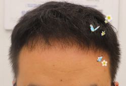 -大麦微针植发全国连锁