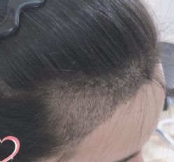 -大麦微针植发丨全国连锁