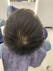 体验后-大麦微针植发全国连锁