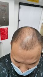 -大麦微针植发全国连锁