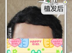 -大麦微针植发全国连锁