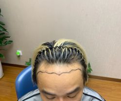 -大麦微针植发全国连锁