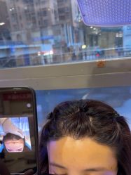 -碧莲盛·不剃发植发