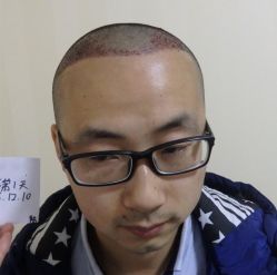 -碧莲盛·不剃发植发