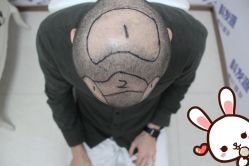 -大麦微针植发丨全国连锁