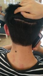 -大麦微针植发丨全国连锁