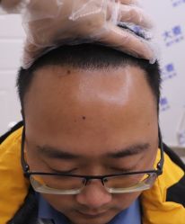 点击看大图 体验后-大麦微针植发全国连锁