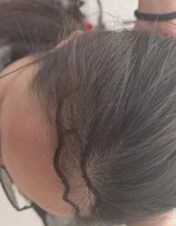 -大麦微针植发丨全国连锁