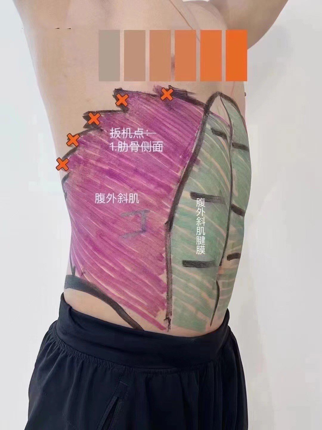 腹肌的损伤也可以引起腰痛\\n比如旋转痛务必检查腹外斜肌\\n​\\n