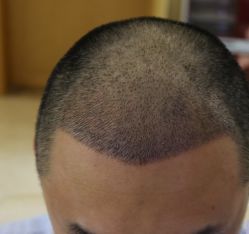 -大麦微针植发全国连锁