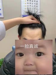 -大麦微针植发全国连锁