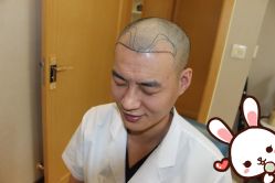 点击看大图 -大麦微针植发丨全国连锁