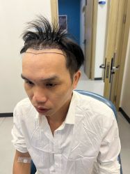 -大麦微针植发全国连锁