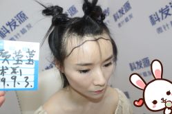 点击看大图 -大麦微针植发丨全国连锁