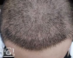 -大麦微针植发丨全国连锁