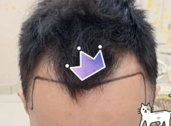 -大麦微针植发全国连锁