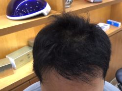 -大麦微针植发全国连锁