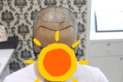 -大麦微针植发全国连锁