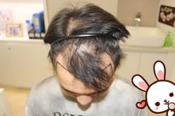 点击看大图 -大麦微针植发丨全国连锁