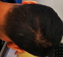 体验后-大麦微针植发全国连锁