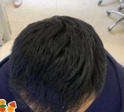 -大麦微针植发丨全国连锁