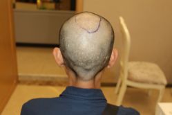 -大麦微针植发丨全国连锁