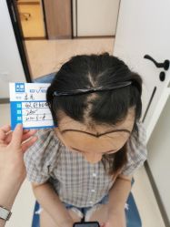 -大麦微针植发丨全国连锁